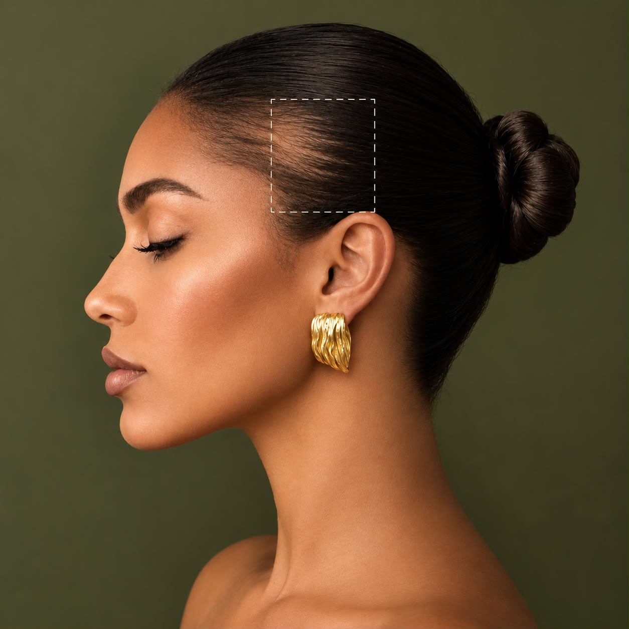 Alopecia de tração — área de tração na linha frontal