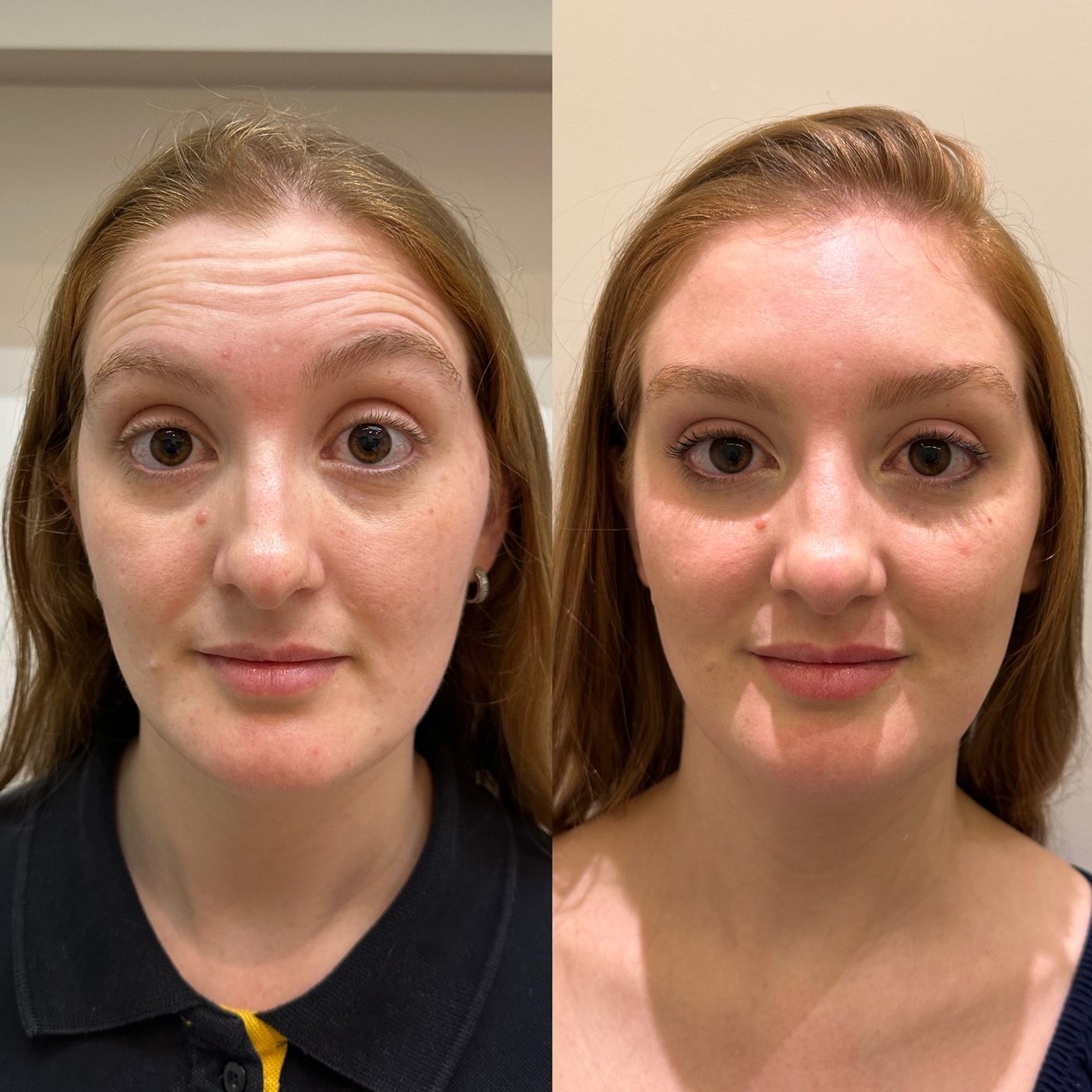 Antes e depois - botox testa e glabela